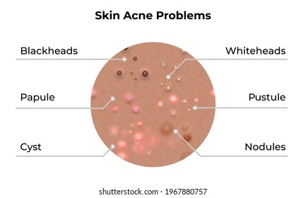 Skin acne types and face pimples for dark skin type, vector, skin care problems treatment. Skin acne dermatology and skincare beauty.