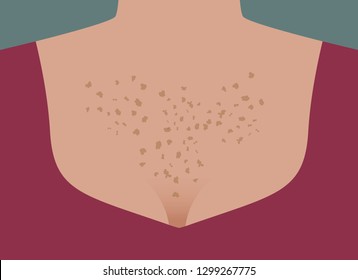 Skin Aging, Spots On Body, Neckline, Protects Skin From Sunburn, Pigmentation On Chest, Freckles On Chest. Vector Illustration