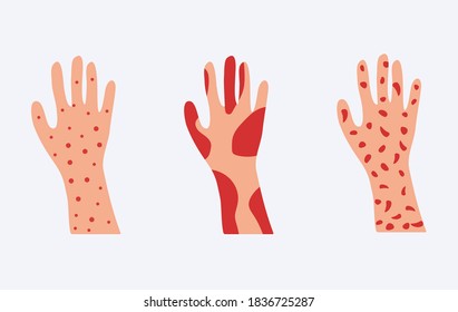 Skin allergy set. Hands covered red rash and scaling serious problems with psoriasis and eczema destruction of epidermis severe allergic dermatitis with rash vector urticaria.