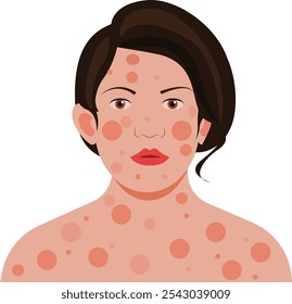 Alergia a la piel: mujer que sufre problemas de la piel, como alergias, psoriasis, eccema, sequedad, enrojecimiento. Enfermedad vírica
