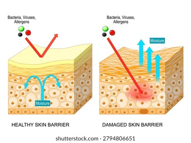 Skin barrier. Cross section of epidermis. Comparison of healthy and damaged skin barrier layers. Lipid layer and Moisture loss. Transepidermal water. Dermatology. Medical illustration. Infographic diagram. Vector