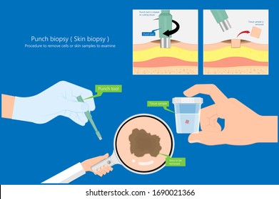 Skin Biopsy Dermoscope Tool Surgical Diagnose Lupus Rash Cell Exam Medical Shave Punch Dermis Layer Superficial Fat ABCDE Rule Sign Check Basal Moles Treat Remove Inflammatory Tags Warts Lab Test Type