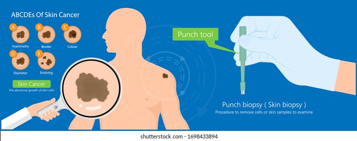 Skin biopsy dermoscope tool surgical diagnose lupus rash cell exam medical Shave Punch dermis layer superficial fat ABCDE rule sign check basal moles treat remove inflammatory tags Warts lab test type