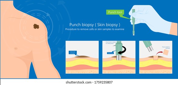 Skin biopsy dermoscope tool surgical diagnose lupus rash cell exam medical Shave Punch dermis layer superficial fat ABCDE rule sign check basal moles treat remove inflammatory tags Warts lab test type