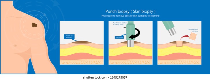 Skin biopsy dermoscope tool surgical diagnose lupus rash cell exam medical Shave Punch dermis layer superficial fat ABCDE rule sign check basal moles treat remove inflammatory tags Warts lab test type