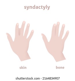 Skin And Bone Syndictalia, Fusion Of Fingers. Genetic Disease. Medical Poster. Vector Illustration