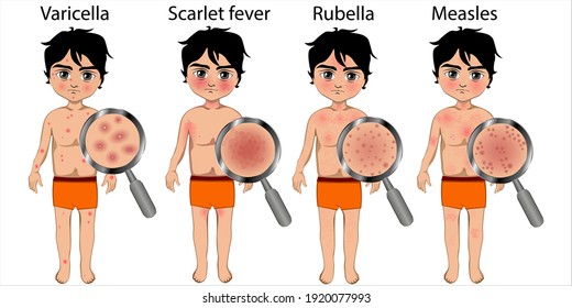 The Skin Of A Boy With Chickenpox, Rubella, Scarlet Fever And Measles. Difference Between Skin Rashes. View Of The Rash Through A Magnifying Glass. Vector Illustration