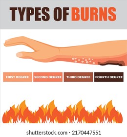 Hautbrennen. Hand gebrannt, Phasen des Brennen. Flache Vektorgrafik-Illustration. Grad der Verbrennung der Haut, der Beschädigung und der medizinischen Versorgung