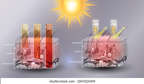 Skin burn classification. First, second and third degree burns. Protected skin with sunscreen lotion. UVB and UVA radiation can not penetrate. Detailed anatomy.