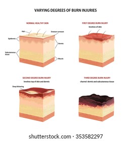 Skin burn classification. First, second and third degree skin burns