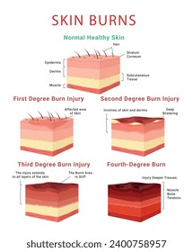 Skin burn classification infographic medical educational scheme poster isometric vector illustration. Physical injury chemical burning epidermis structure first second third and fourth degree