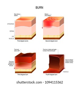 skin burn. four degrees of burns. type of injury to skin. step of burn