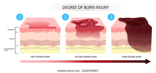 Skin burn injury degree of epidermis tissue layer with flames exposure