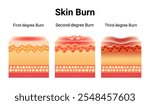 Skin Burn Injury Stages Anatomy Skin