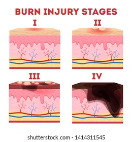 First Degree Burn High Res Stock Images Shutterstock