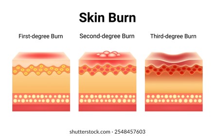 Lesión por quemadura en la piel Estadios Anatomía de la piel
