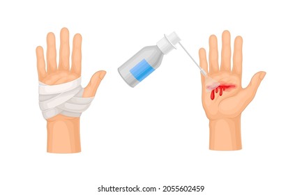 Skin burn injury treatment. First aid for thermal wound. Medicine for cure and bandaging vector illustration