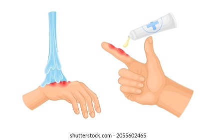 Skin burn injury treatment. First aid for burn wound vector illustration