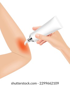 Skin burn injury treatment. First aid for burn wound vector illustration, elbow with skin injury. vector illustration. EPS10.