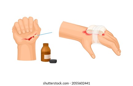 Skin burn injury treatment. Hurt human hand with first aid bandage vector illustration