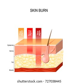 skin burn. Layers of the skin.  First, second and third degree skin burns