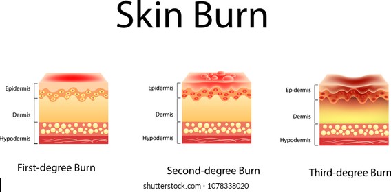 skin burn. Three degrees of burns. type of injury to skin, Vector illustration