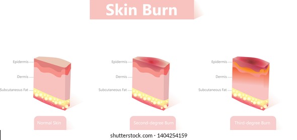 84 Injury Skin Layers Stock Vectors, Images & Vector Art 