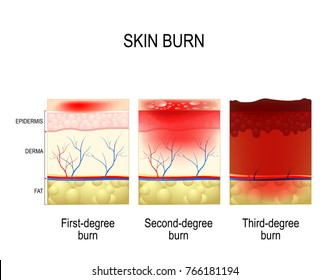 skin burn. Three degrees of burns. type of injury to skin. step of burn
