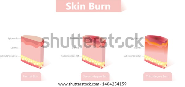 Skin Burn Three Degrees Burns Stock Vector (royalty Free) 1404254159 