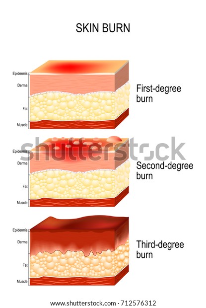 Br lure De Peau Trois Degr s De Image Vectorielle De Stock libre De br-lure-de-peau-trois-degr-s-de-image-vectorielle-de-stock-libre-de