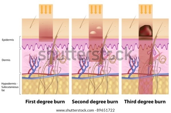 Skin Burns Stock Vector (royalty Free) 89651722 