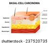 basal carcinoma