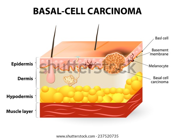 skin cancer. Basal-cell
carcinoma or basal cell cancer (BCC). Schematic representation of
skin. Melanocytes are also present and serve as the source cell for
melanoma.