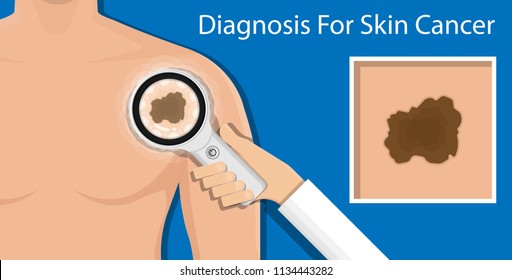 Skin cancer diagnosis dermatology screening examination UVB prevent squamous treat basal Examine test UV