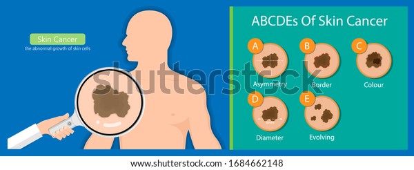 Skin cancer\
diagnosis dermatology screening examination UVB prevent squamous\
treat basal test ABCDEs rule\
sun