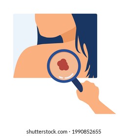 Skin Cancer Diagnosis. Doctor Detecting Asymmetric Evolving Spot On Skin. Melanoma, Dermatology, Mole Screening, Birthmark. For Topics Like Prevention, Medicine, Physical Exam