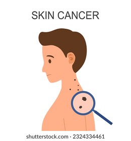 Skin cancer disease on man skin in flat design.