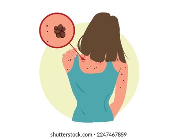 Skin cancer melanoma dermatology problem concept. Health care. Cartoon people vector.