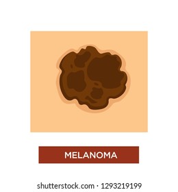 Skin Cancer Or Melanoma Disease Dangerous Mole Vector Birthmark Or Dark Spot On Human Body Treatment And Chemotherapy Dermatology And Oncology Carcinoma And Nevus Or Malignant Or Benign Tumor.