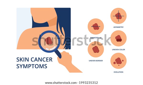 Skin cancer symptoms like big diameter,\
asymmetry, uneven color, uneven border and evolution next to hand\
of doctor detecting melanoma spot on skin of\
woman