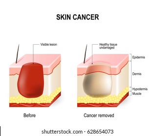 Skin Cancer Treatment. Surgically Removes. Skin Section With Melanoma (before Surgery) And Skin Is Free Of Cancer (after Cure).