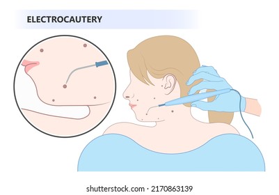 skin care clinic tag cancer face tumor lesion treat warts mole laser gland milia cysts cell inflamed Basal cell layer solar sun spots