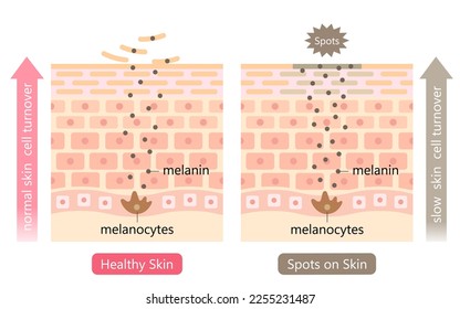 skin cell turnover and dark spot on skin before after illustration. Beauty and skin care concept