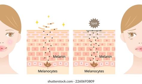 skin cell turnover and dark spot on young woman’s face before after illustration. Beauty and skin care concept