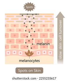 Hautfluktuation und dunkle Flecken. Melanin und Melanozyten in der menschlichen Hautschicht. Beauty- und Hautpflegekonzept
