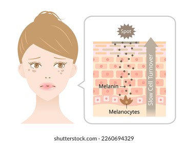 Hautfluktuation und dunkle Stellen im Gesicht der jungen Frau. Melanin und Melanozyten in der menschlichen Hautschicht. Beauty- und Hautpflegekonzept