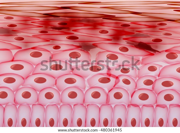 Skin Cells, Eczema, Inflamed Skin Layers -\
Vector Illustration
