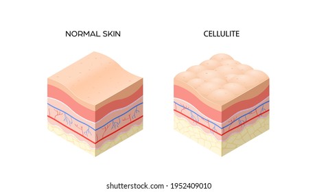 skin with cellulite and normal skin cross-section of human skin layers structure skincare medical concept flat horizontal