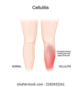 Skin cellulitis. Comparison and difference of Healthy leg, and leg with symptoms of Infectious disease. bacterial infection involving the inner layers of the skin. dermatology. vector illustration