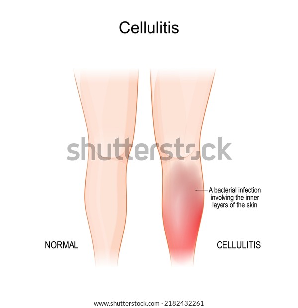 Skin cellulitis. Comparison and difference\
of Healthy leg, and leg with symptoms of Infectious disease.\
bacterial infection involving the inner layers of the skin.\
dermatology. vector\
illustration
